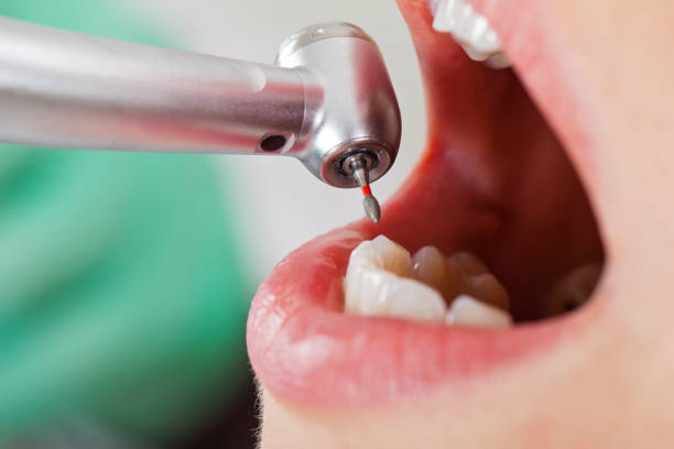 Best Emergency Tooth Extraction in Hartford, IL